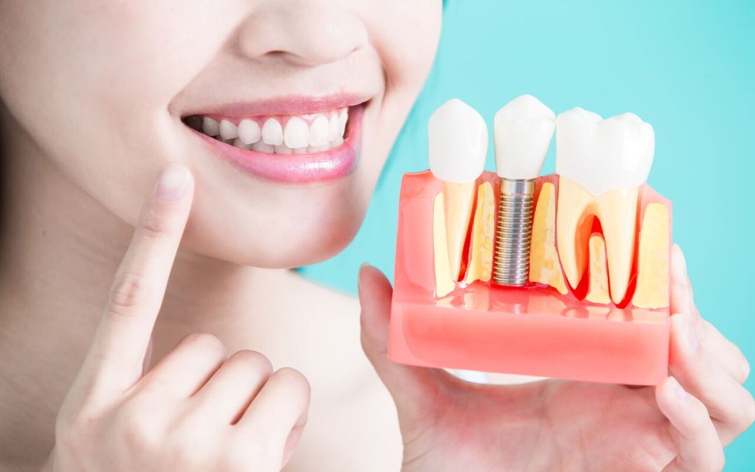Types of Missing Teeth Replacements