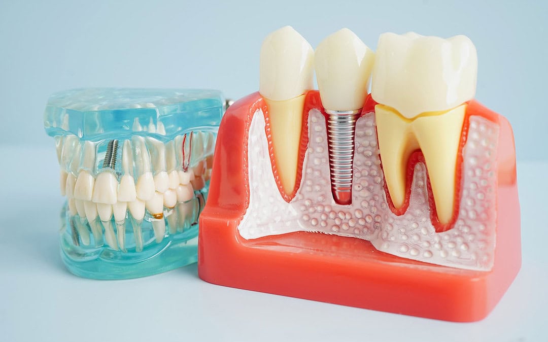 Explore Safe and Easy to Care for Dental Implants