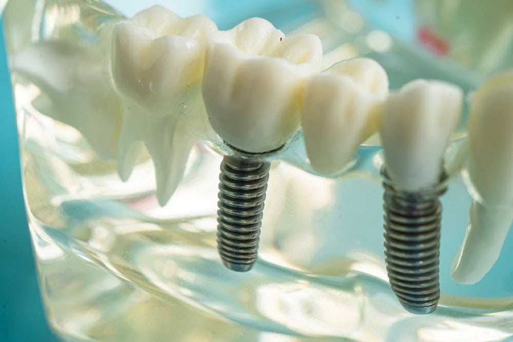 A model of tooth implants