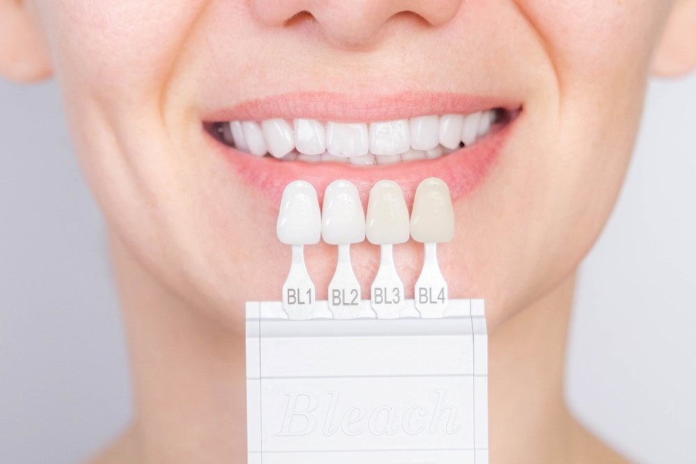 Differences Between Porcelain and Composite Veneers