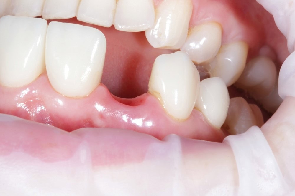 Why are My Teeth Falling Out?