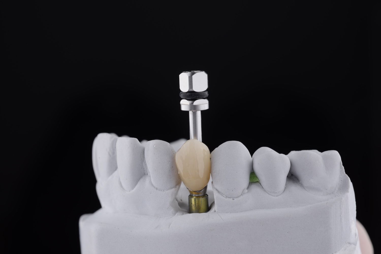 A model of a single tooth implant