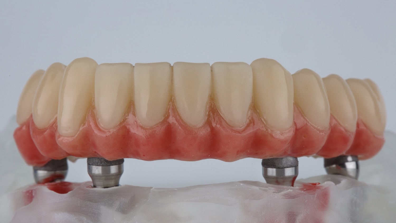 A model of a lower jaw all-on-4 dental implant