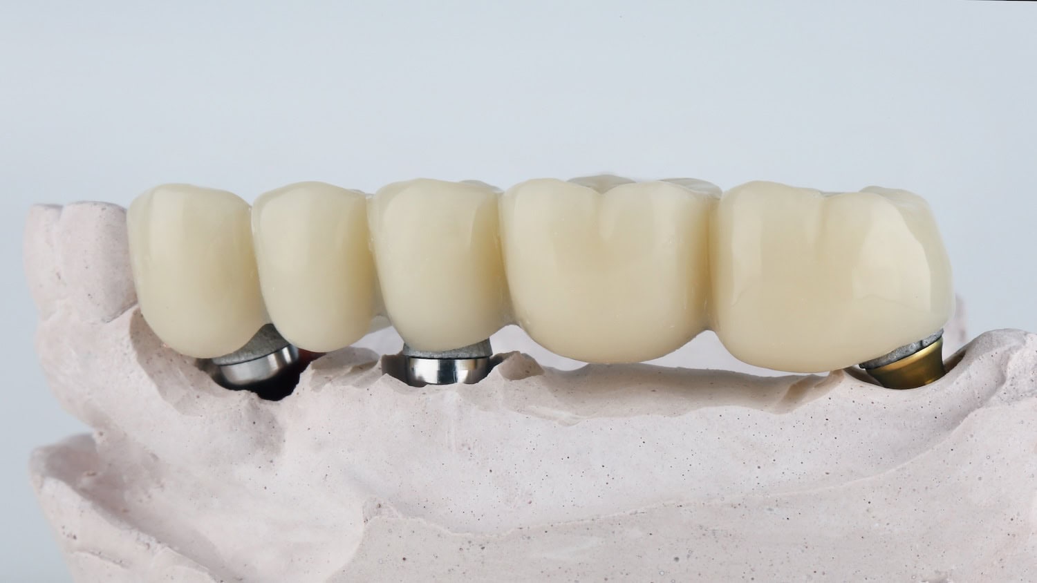 A model of an implant bridge