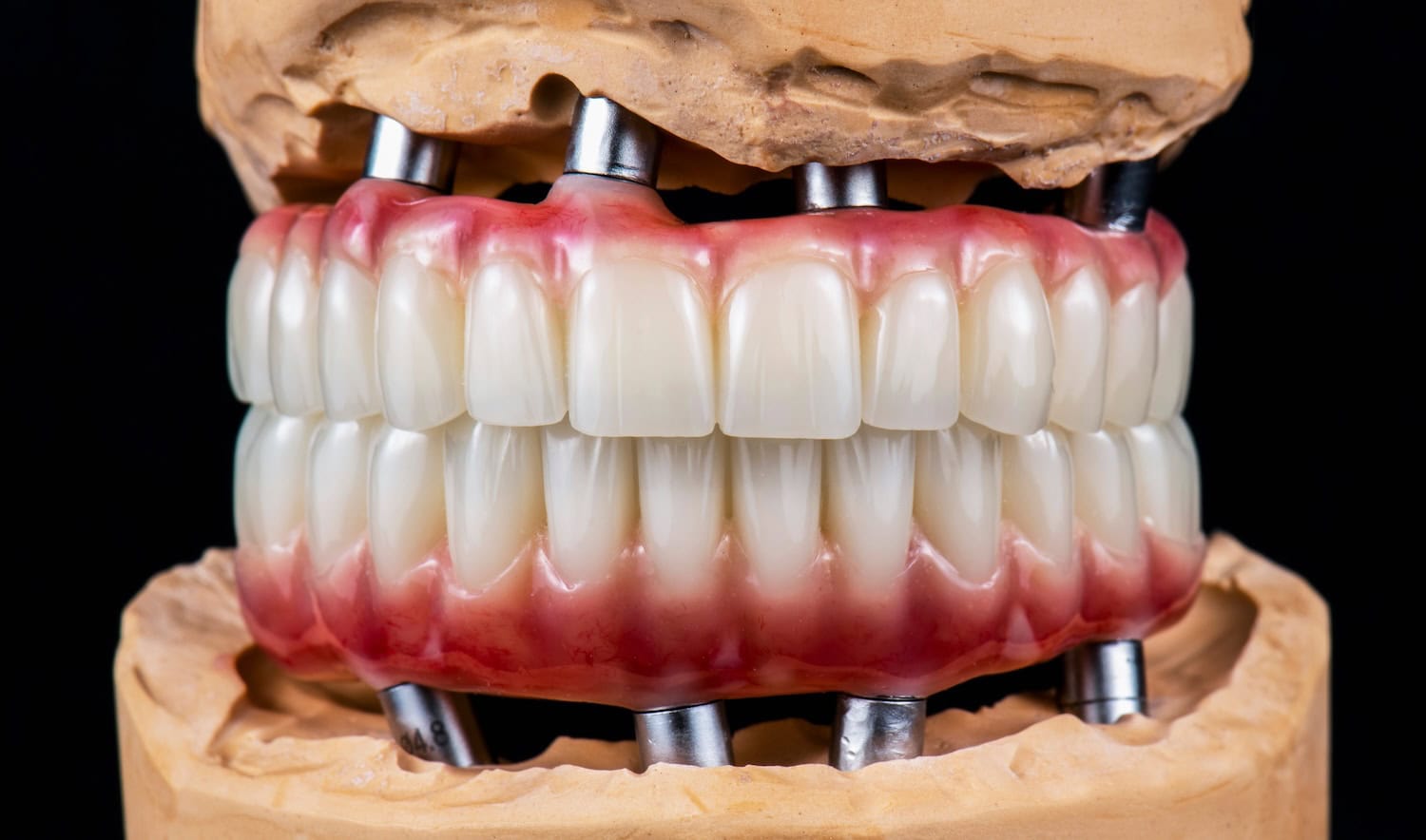 A model of full-mouth implants